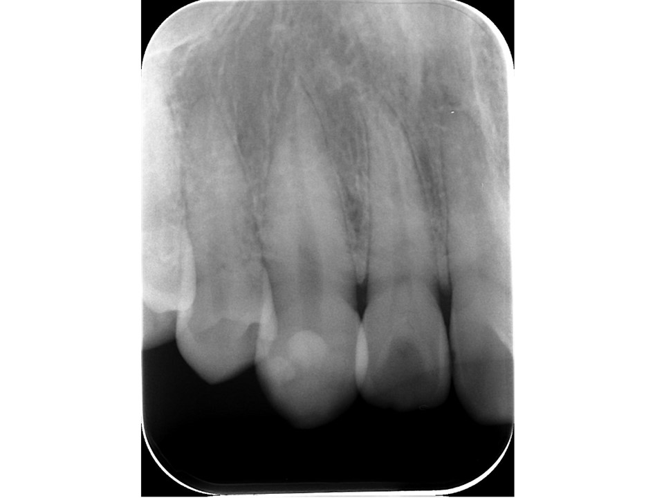 歯科用デジタル・レントゲン